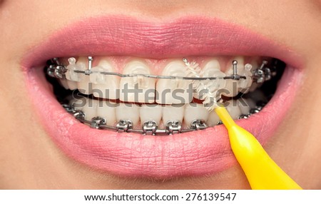 Dental Hygiene of Teeth with Braces. Oral  Health Concept. Female Mouth with Interdental Brush. Front View.