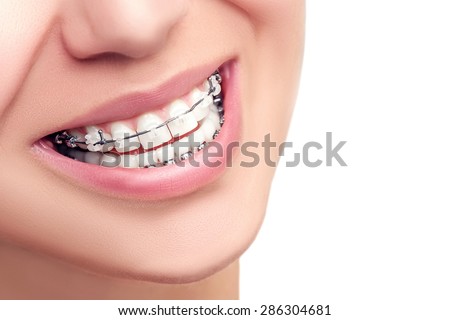 Braces. Orthodontic Treatment. Dental Care Concept. Beautiful Woman Healthy Smile close up. Closeup Ceramic and Metal Brackets on Teeth. Beautiful Female Smile with Braces.