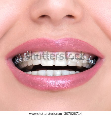 Closeup Ceramic and Metal Braces on Teeth. Self-ligating Brackets. Orthodontic Treatment. Woman Smiling Showing Dental Braces.