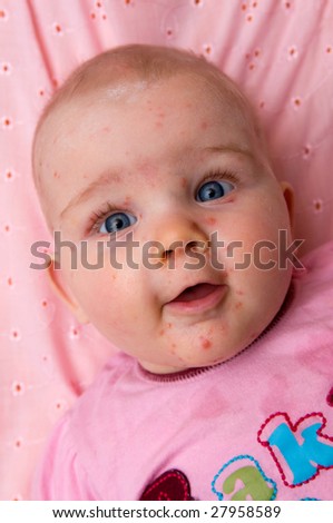 A baby with chicken-pox on a pink sheet
