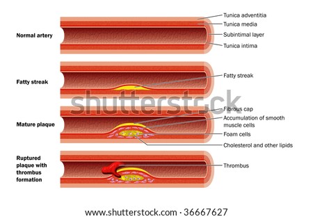 atheroma formation