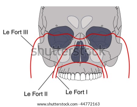 Lefort 3 Fracture