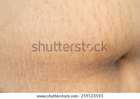 Close up scar on skin of woman pregnant