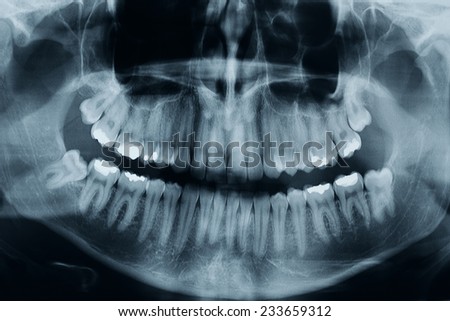 Dental xray shows 3 wisdom tooths. there is one critical in the lower part of the picture, this is a high resolution, photo