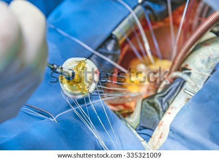 Implantation of a biological heart valve