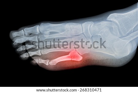 x-ray image of bone fracture