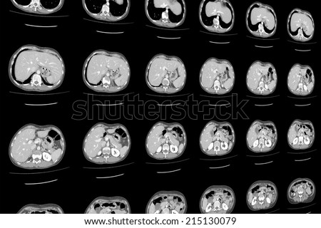 CT scan of upper abdomen in top view.
