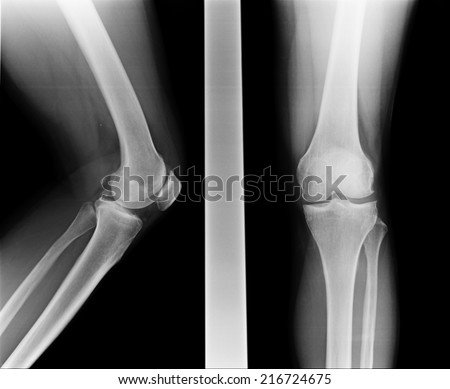 X-ray image Knee