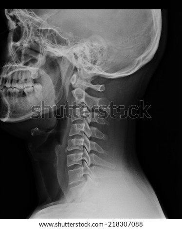 x-ray of the cervical spine