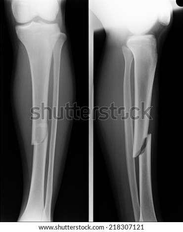 x-ray image show fracture both bone of leg and fracture shaft of ulnar of forearm