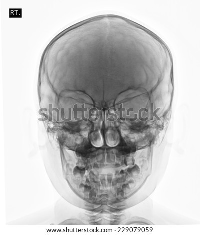 Front face skull x-ray image