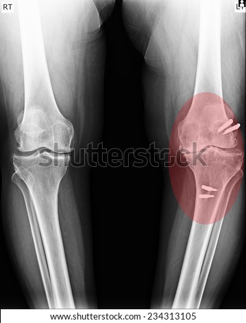 knee x-rays image showing plate and screw fixation