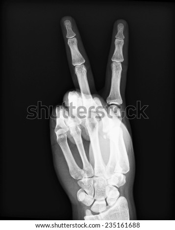 X-ray of both human hand