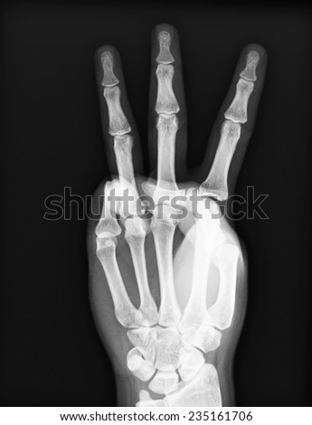 X-ray of both human hand