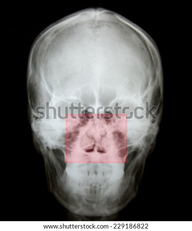 X ray of nasal bone fracture after accident