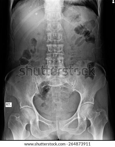 X-ray of the pelvis and spinal column of a woman