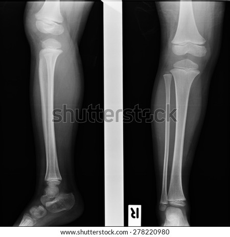X-ray of broken leg with plate and screws.
