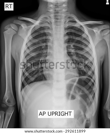 X-ray image of Abdomen supine position.