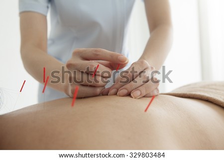 Adult female physiotherapist is doing acupuncture on the back of a female patient.