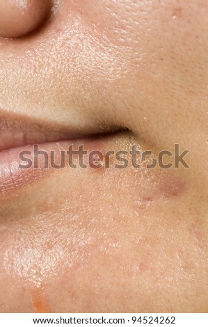 Acne on woman, great for your health niche design