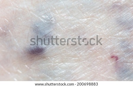 varicose veins in the leg