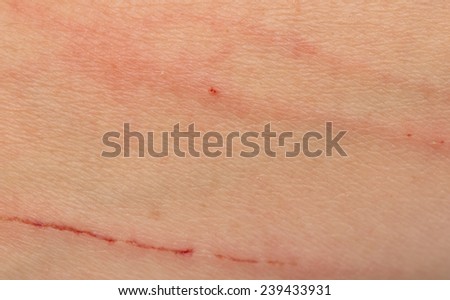 scratches on the skin
