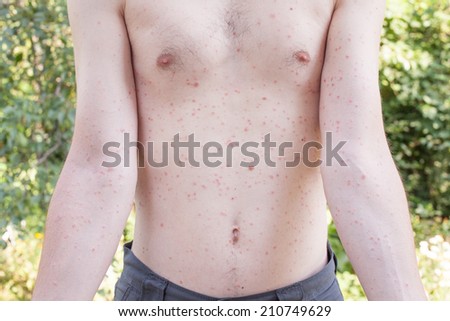 Man shows his torso and arms with pink rash Man shows his torso and arms with pink rash