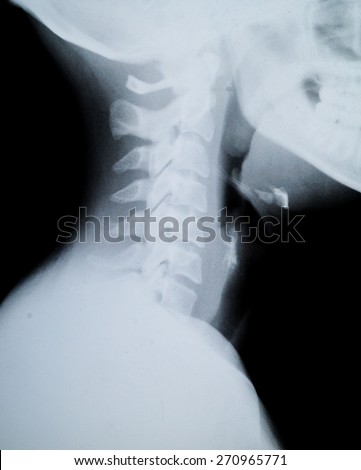 X ray of Human neck and Jaw