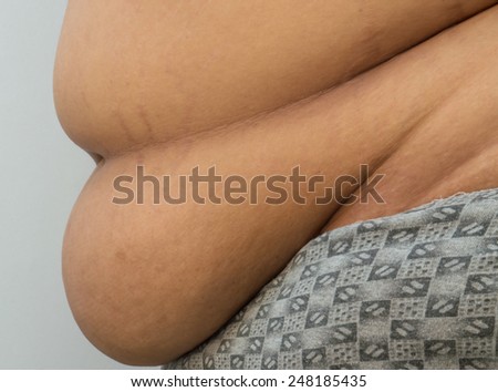 Obese people with belly fat