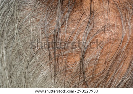 Balding gray hair