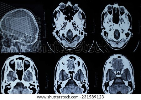 Photo of the CT and MRI of the skull