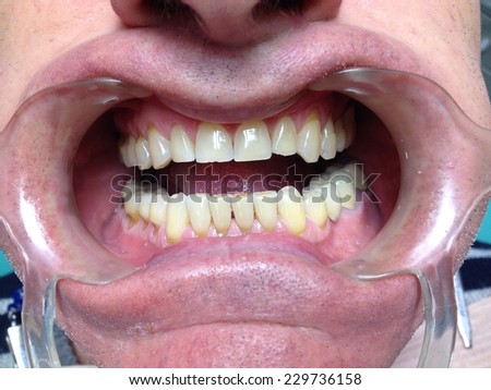 Unhealthy denture and teeth abrasion result of incorrect teeth cleaning