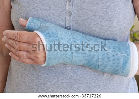 Woman\'s left arm in blue cast