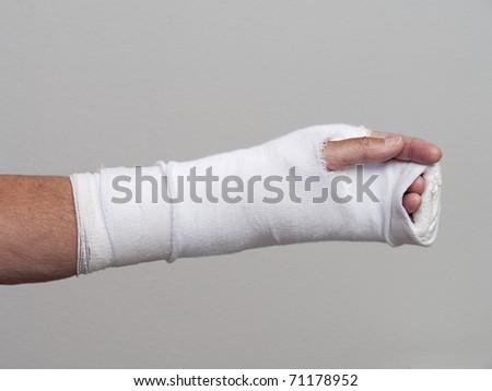 Long bandaged cast on hand and arm