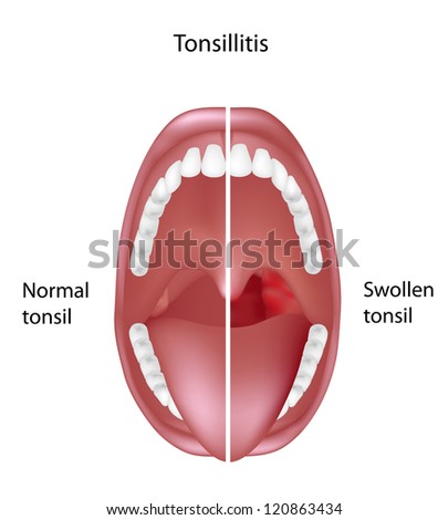 Non Painful White Patches On Tongue