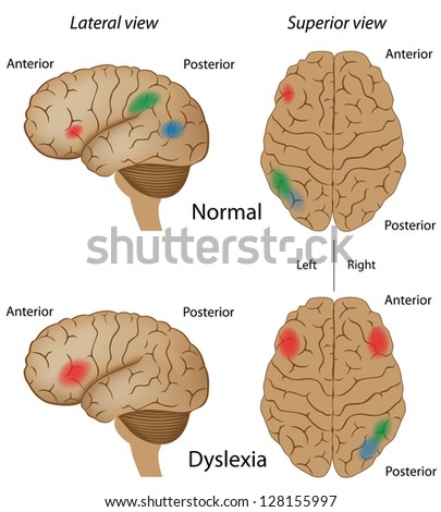 Dyslexia brain activity Dyslexia brain activity