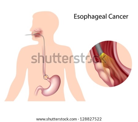Esophageal cancer Esophageal cancer