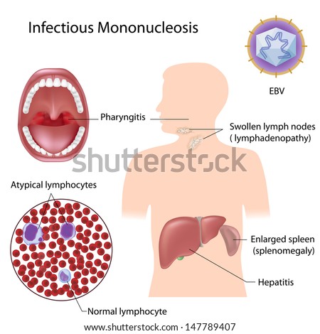 Infectious Mononucleosis Infectious Mononucleosis