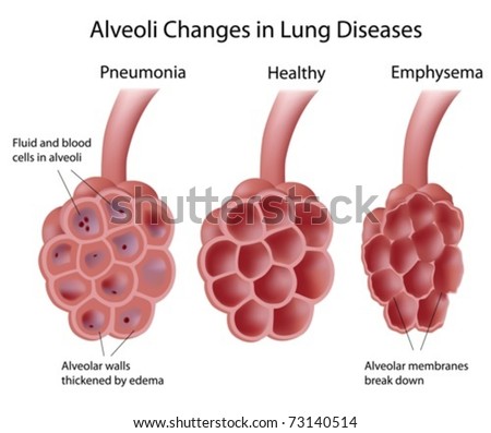 Pictures Of Alveoli