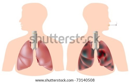 smoking lungs and healthy lungs. stock vector : Smoker#39;s lung