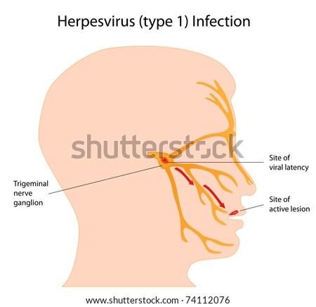 herpes virus diagram. stock photo : Herpesvirus infection (cold sores)