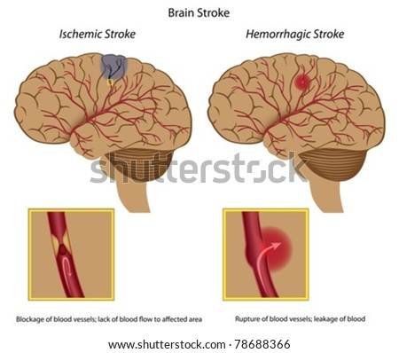 Brain Stroke - Ischemic And Hemorrhagic Stock Vector Illustration ...