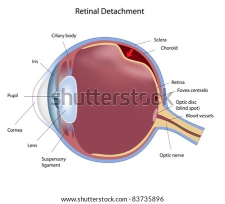 eye detachment