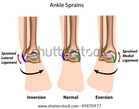 Types of ankle sprains Types of ankle sprains