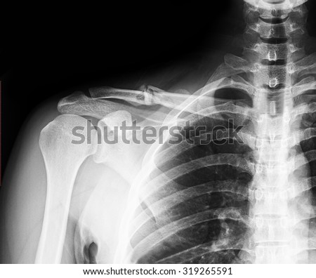 X-ray image of clavicle. Clavicle fracture.