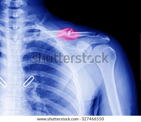 X-ray image of left clavicle fracture , after treatment for 4 weeks.