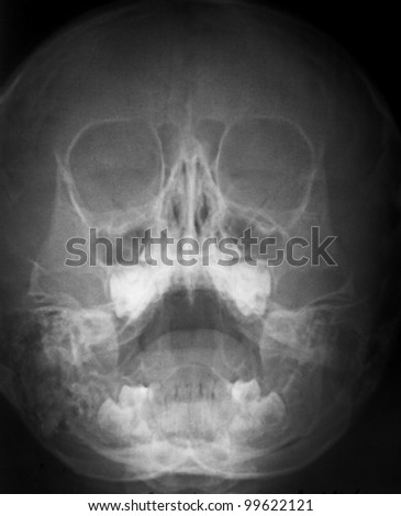 x-ray of a human skull in black and white