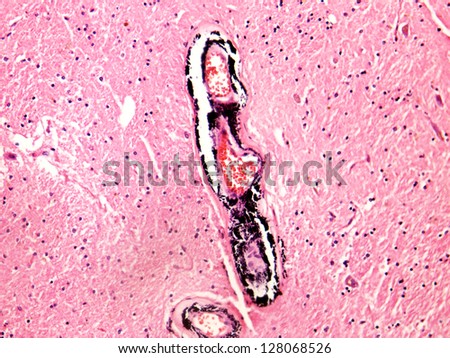 Arterial media calcification of vessels of a human brain, photomicrograph panorama as seen under the microscope, 200x zoom.
