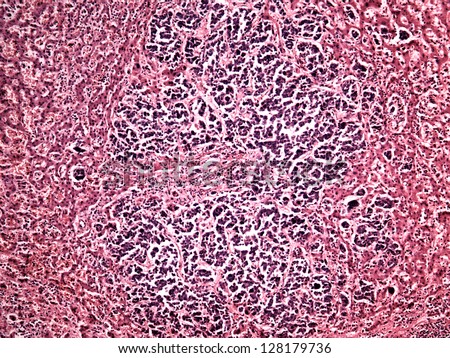 Liver cancer of a human, photomicrograph panorama as seen under the microscope, 100x zoom.