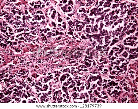 Liver cancer of a human, photomicrograph panorama as seen under the microscope, 200x zoom.